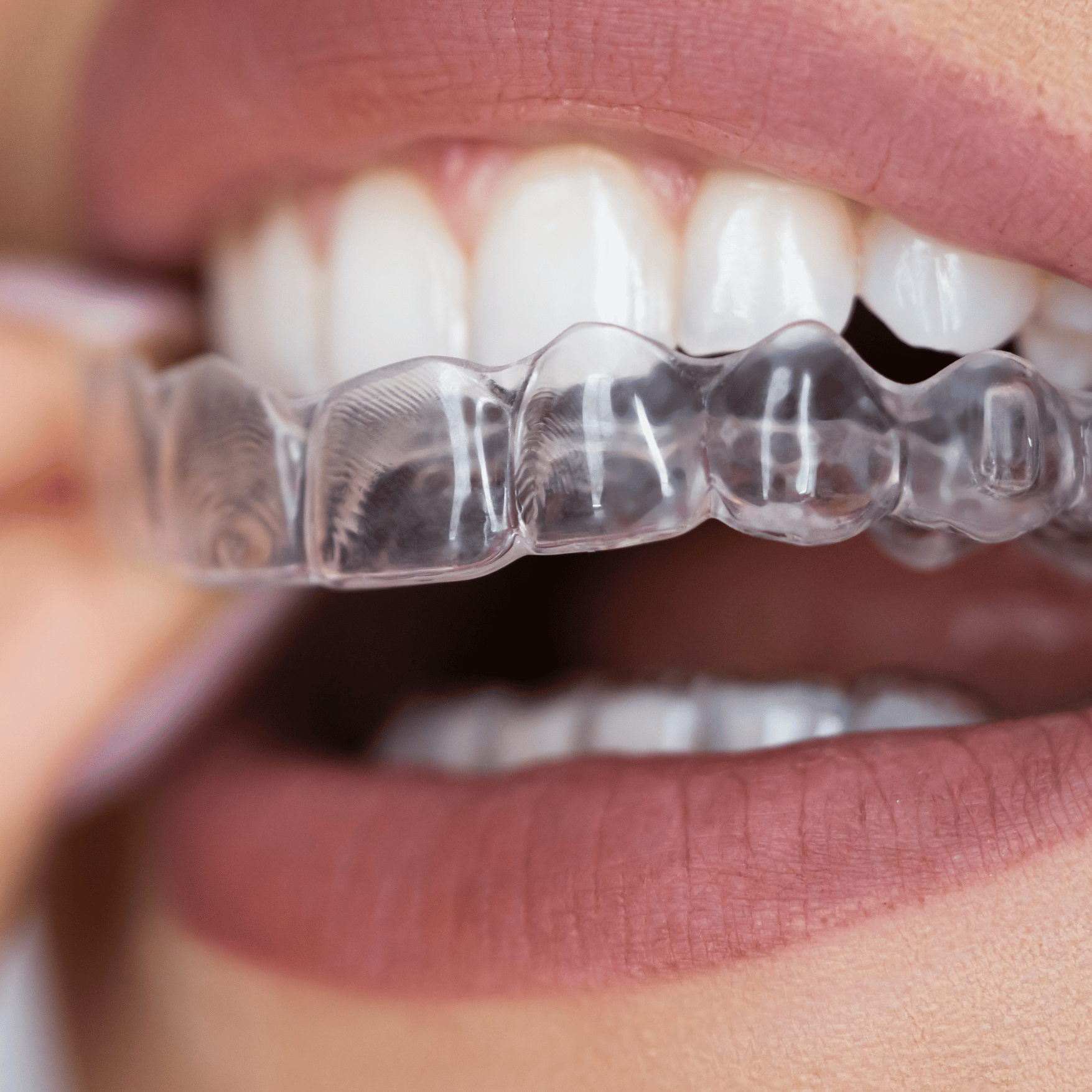 Kaperavi (inglise keeles clear aligners) on tänapäevane ortodontiline ravimeetod, mis võimaldab hambaid sirgendada ilma traditsiooniliste metallbreketiteta. Läb